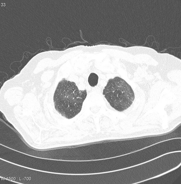File:Amiodarone lung (Radiopaedia 6539-7851 Axial lung window 2).jpg