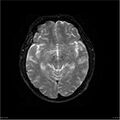 Amnestic syndrome secondary to hypoxic brain injury (Radiopaedia 24743-25004 DWI 46).jpg
