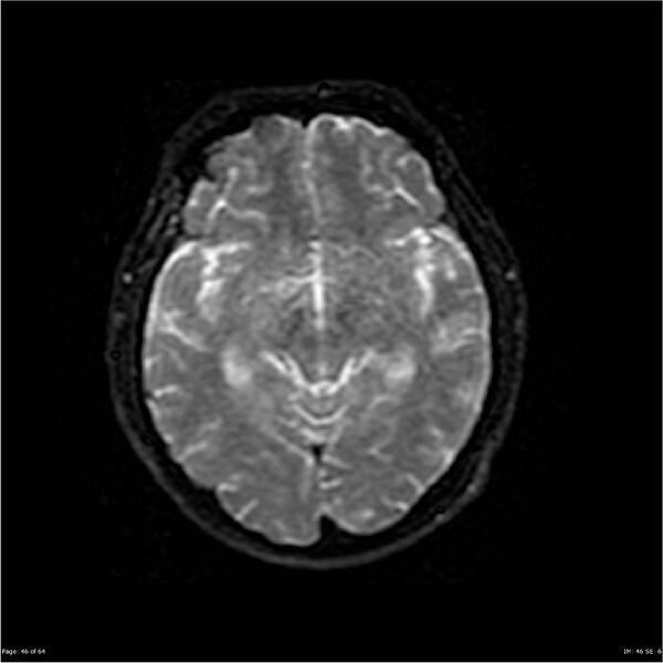 File:Amnestic syndrome secondary to hypoxic brain injury (Radiopaedia 24743-25004 DWI 46).jpg