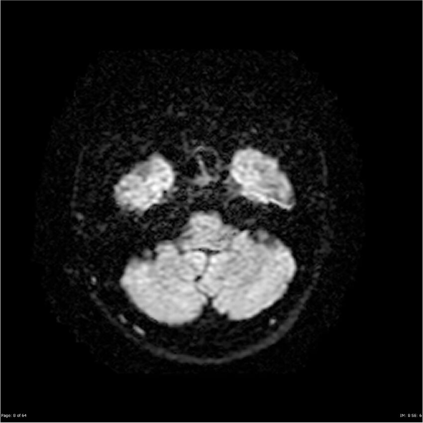 Amnestic syndrome secondary to hypoxic brain injury (Radiopaedia 24743-25004 DWI 8).jpg