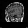 Amnestic syndrome secondary to hypoxic brain injury (Radiopaedia 24743-25004 T1 16).jpg