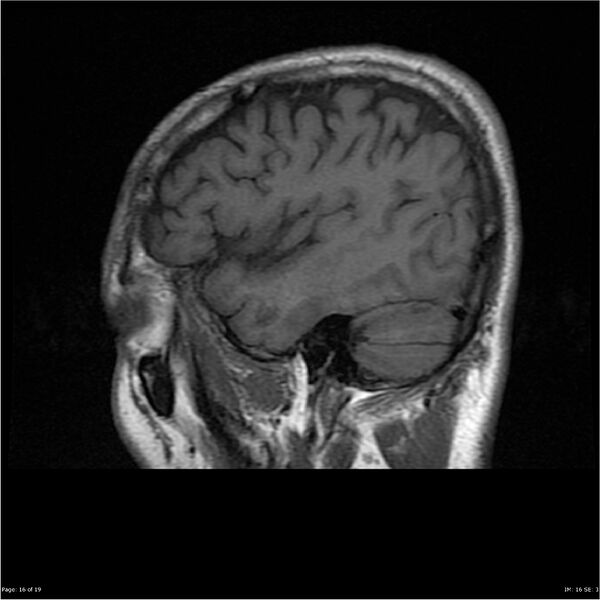 File:Amnestic syndrome secondary to hypoxic brain injury (Radiopaedia 24743-25004 T1 16).jpg