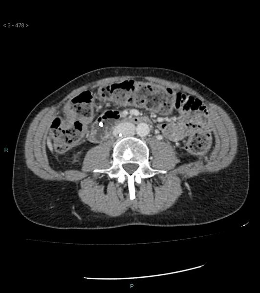 File:Ampulla of Vater metastasis (Radiopaedia 27820-28069 A 116).jpg
