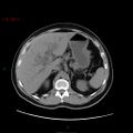 Ampullary carcinoma (Radiopaedia 56396-63056 Axial non-contrast 15).jpg