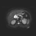 Ampullary tumor (Radiopaedia 27294-27479 T2 SPAIR 10).jpg