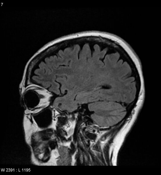 File:Amyotrophic lateral sclerosis (Radiopaedia 5373-7134 Sagittal FLAIR 3).jpg