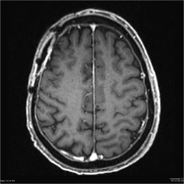 File:Anaplastic meningioma with recurrence (Radiopaedia 34452-35788 Axial T1 C+ 111).jpg