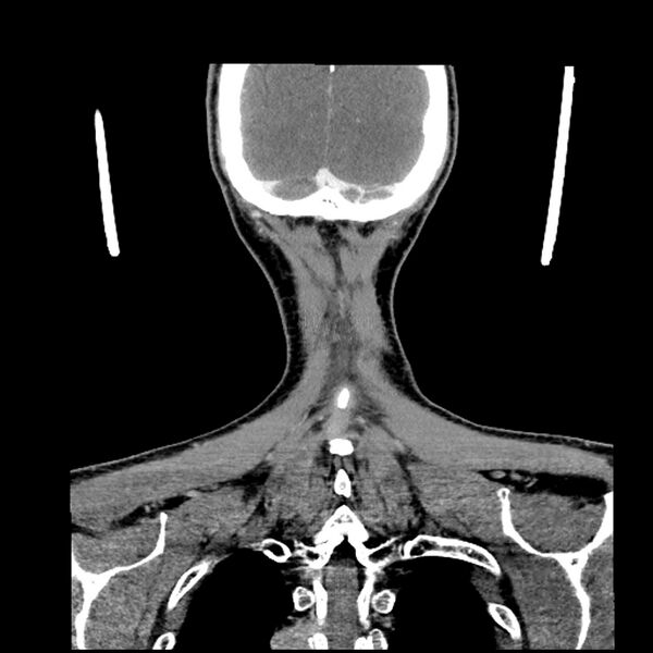 File:Anaplastic thyroid carcinoma (Radiopaedia 79087-92034 A 103).jpg