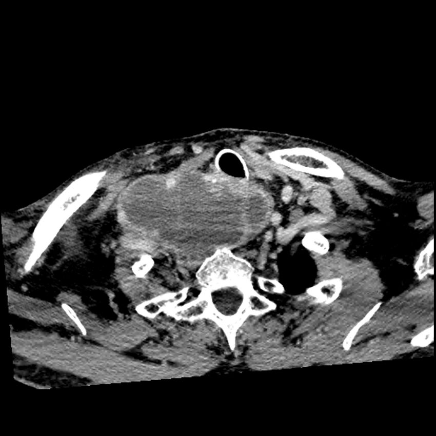 Anaplastic thyroid carcinoma (Radiopaedia 79087-92034 B 35).jpg