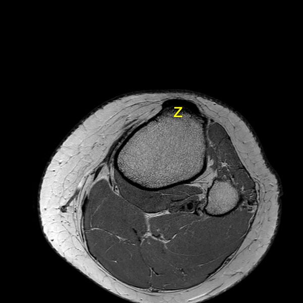 File:Anatomy Quiz (MRI knee) (Radiopaedia 43478-46866 A 28).jpeg