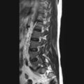 Ankylosing spondylitis with zygapophyseal arthritis (Radiopaedia 38433-40516 Sagittal T2 2).jpg