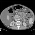 Annular pancreas and cirrhosis (Radiopaedia 24561-24843 A 12).jpg