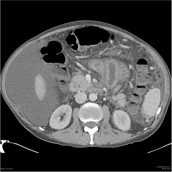 File:Annular pancreas and cirrhosis (Radiopaedia 24561-24843 A 12).jpg
