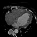 Anomalous left coronary artery from the pulmonary artery (ALCAPA) (Radiopaedia 40884-43586 A 53).jpg