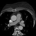 Anomalous origin of left circumflex artery from right coronary sinus (Radiopaedia 72563-83117 B 13).jpg