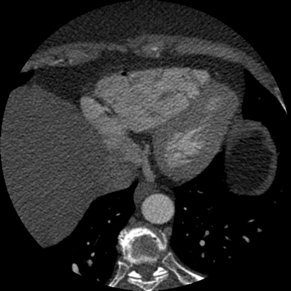 File:Anomalous origin of left circumflex artery from right coronary sinus (Radiopaedia 72563-83117 B 143).jpg
