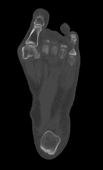 File:Anterior calcaneal process fracture (Radiopaedia 47384-51989 Axial bone window 28).png