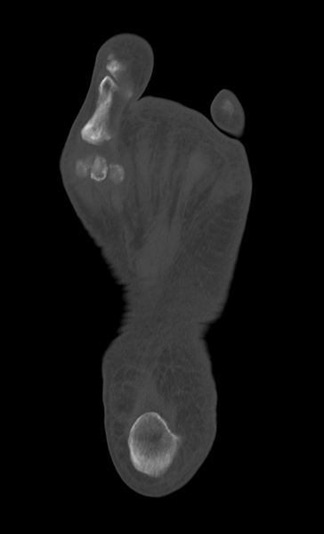 File:Anterior calcaneal process fracture (Radiopaedia 47384-51989 Axial bone window 30).png