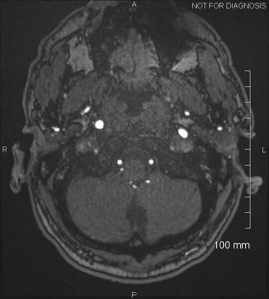 File:Anterior cerebral artery aneurysm (Radiopaedia 80683-94127 Axial MRA 16).jpg