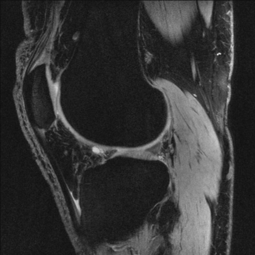 Anterior cruciate ligament mucoid degeneration (Radiopaedia 68400-77933 Sagittal 20).jpg