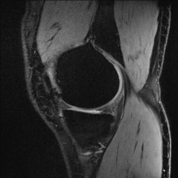 File:Anterior cruciate ligament mucoid degeneration (Radiopaedia 68400-77933 Sagittal 52).jpg