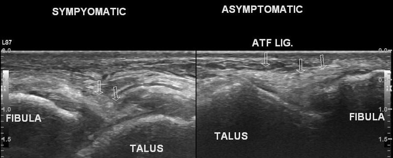File:Anterior talofibular ligament injury (Radiopaedia 53338-59320 B 1).jpg