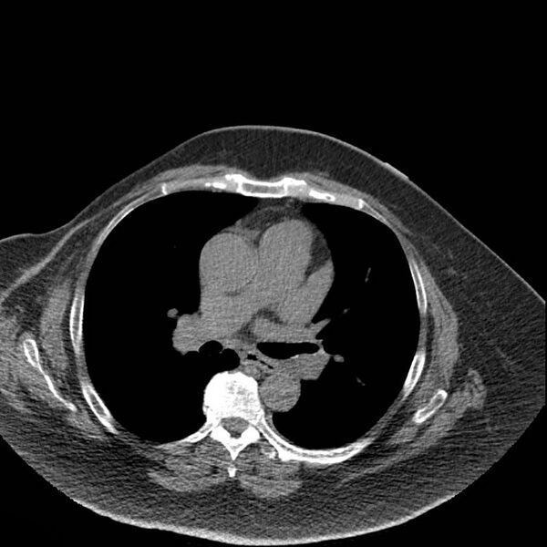 File:Aortic arch false aneurysm (Radiopaedia 14667-14587 Axial non-contrast 24).jpg