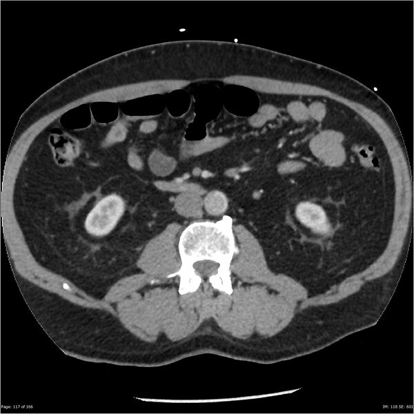 File:Aortic dissection- Stanford A (Radiopaedia 37759-39664 A 108).jpg