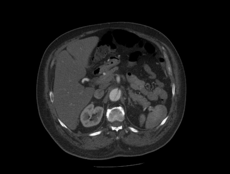 File:Aortic dissection (Radiopaedia 28802-29105 A 48).jpg