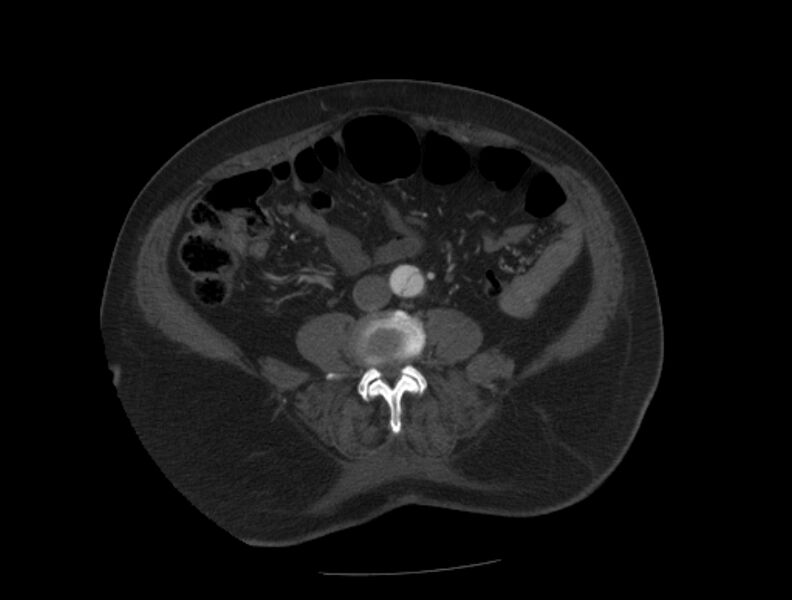File:Aortic dissection (Radiopaedia 28802-29105 A 73).jpg