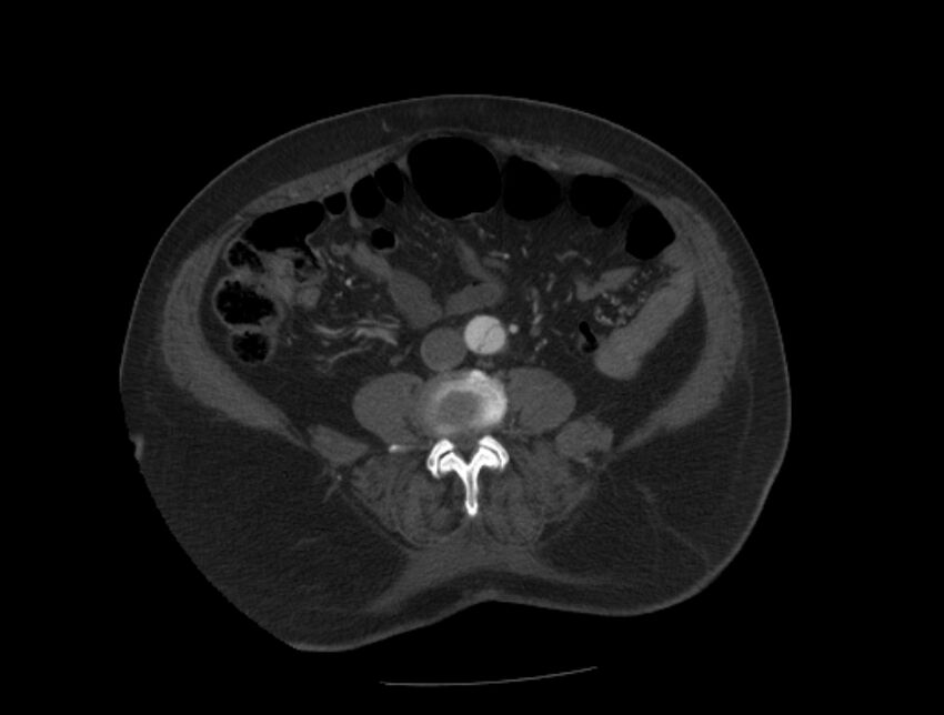Aortic dissection (Radiopaedia 28802-29105 A 73).jpg
