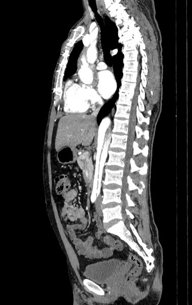 File:Aortic dissection - Stanford type A (Radiopaedia 83418-98500 B 29).jpg