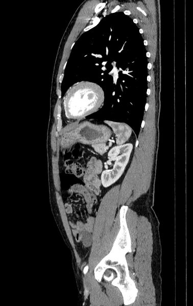 File:Aortic dissection - Stanford type A (Radiopaedia 83418-98500 B 73).jpg