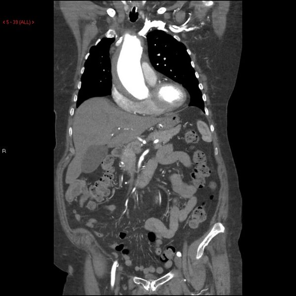 File:Aortic intramural hematoma (Radiopaedia 27746-28001 B 16).jpg