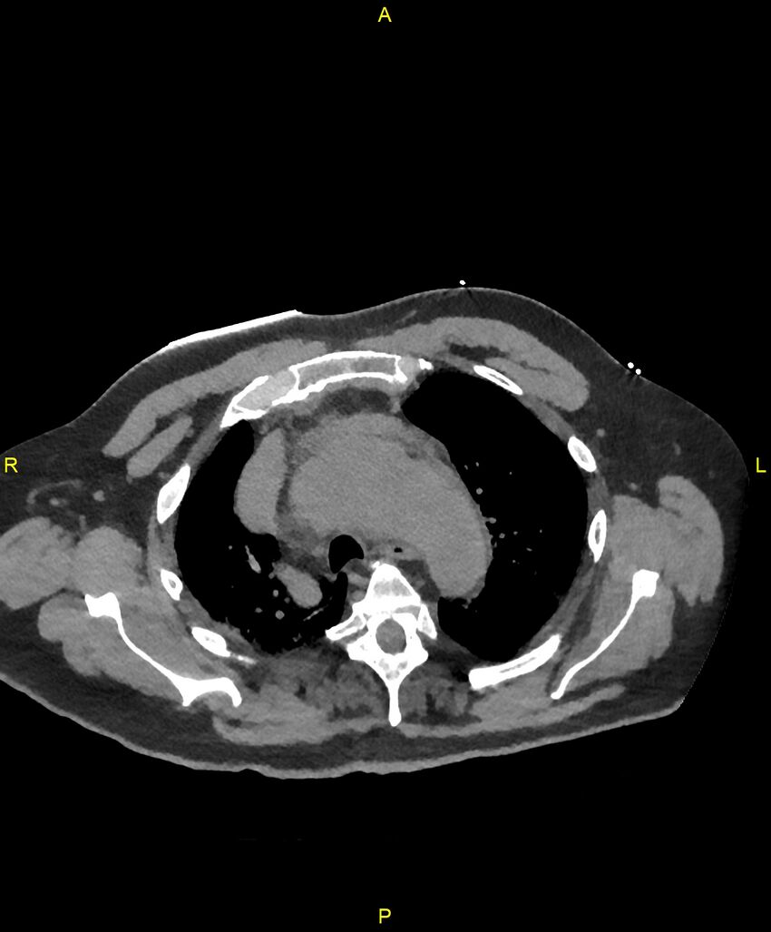 Aortic rupture (Radiopaedia 88822-105594 Axial non-contrast 49).jpg