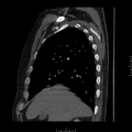 Aorto-coronary bypass graft aneurysms (Radiopaedia 40562-43157 C 2).png