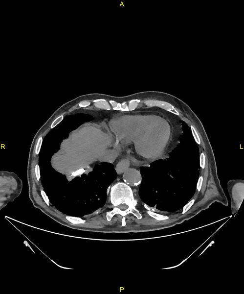 File:Aortoenteric fistula (Radiopaedia 84308-99603 Axial non-contrast 9).jpg