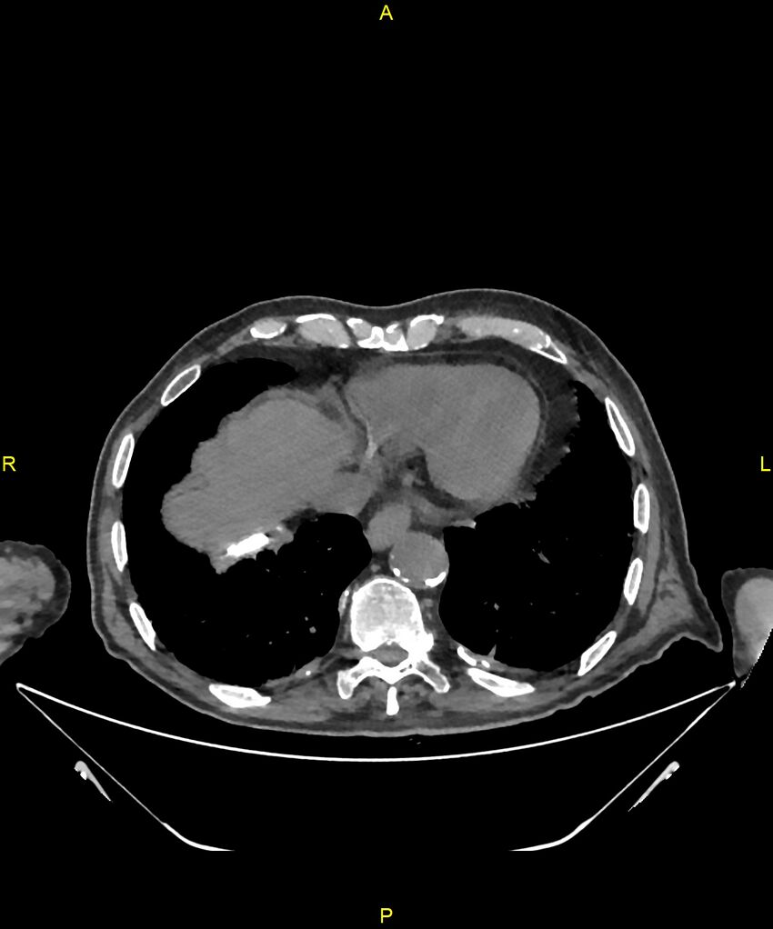 Aortoenteric fistula (Radiopaedia 84308-99603 Axial non-contrast 9).jpg