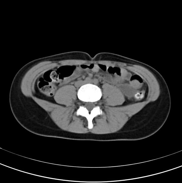 File:Appendicitis and incidental bicornuate uterus (Radiopaedia 22833-22853 Axial non-contrast 27).jpg