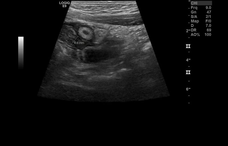 File:Appendicitis and incidental foregut duplication cyst (Radiopaedia 52962-58918 A 11).jpg
