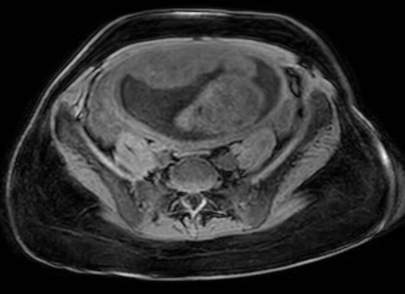 File:Appendicitis in gravida (MRI) (Radiopaedia 89433-106395 Axial DIXON 103).jpg