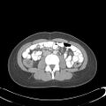 Appendicitis with minimal stranding but appendicolith (Radiopaedia 29035-29397 A 45).jpg