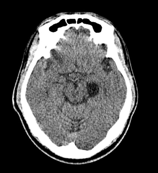 File:Arachnoid cyst of the ambient cistern (Radiopaedia 81301-94986 Axial non-contrast 28).jpg