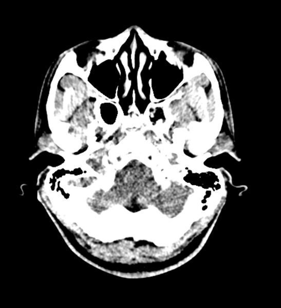 File:Arachnoid cyst of the ambient cistern (Radiopaedia 81301-94986 Axial non-contrast 9).jpg