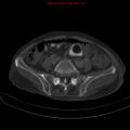 Arachnoiditis ossificans (Radiopaedia 51394-57136 Axial bone window 30).jpg