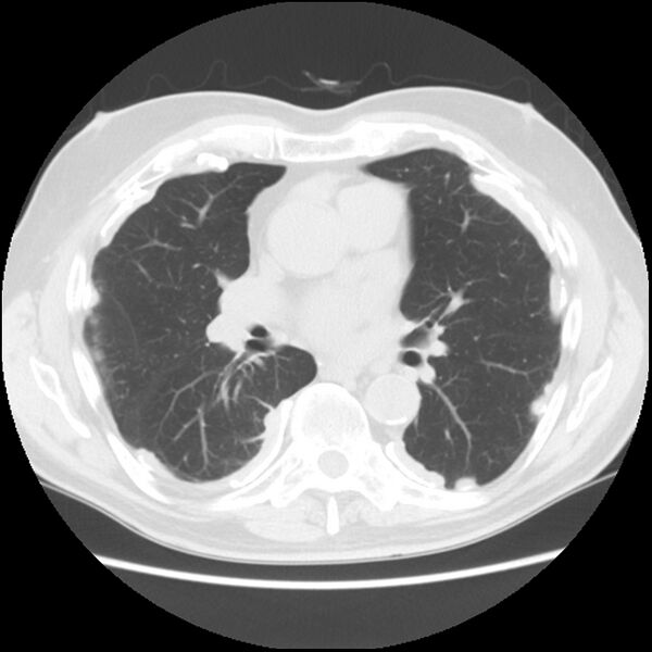 File:Asbestos-related pleural plaques (Radiopaedia 39069-41255 Axial lung window 38).jpg