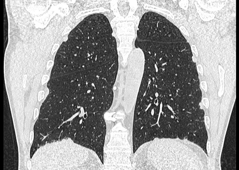 File:Asbestos pleural placques (Radiopaedia 57905-64872 Coronal lung window 206).jpg