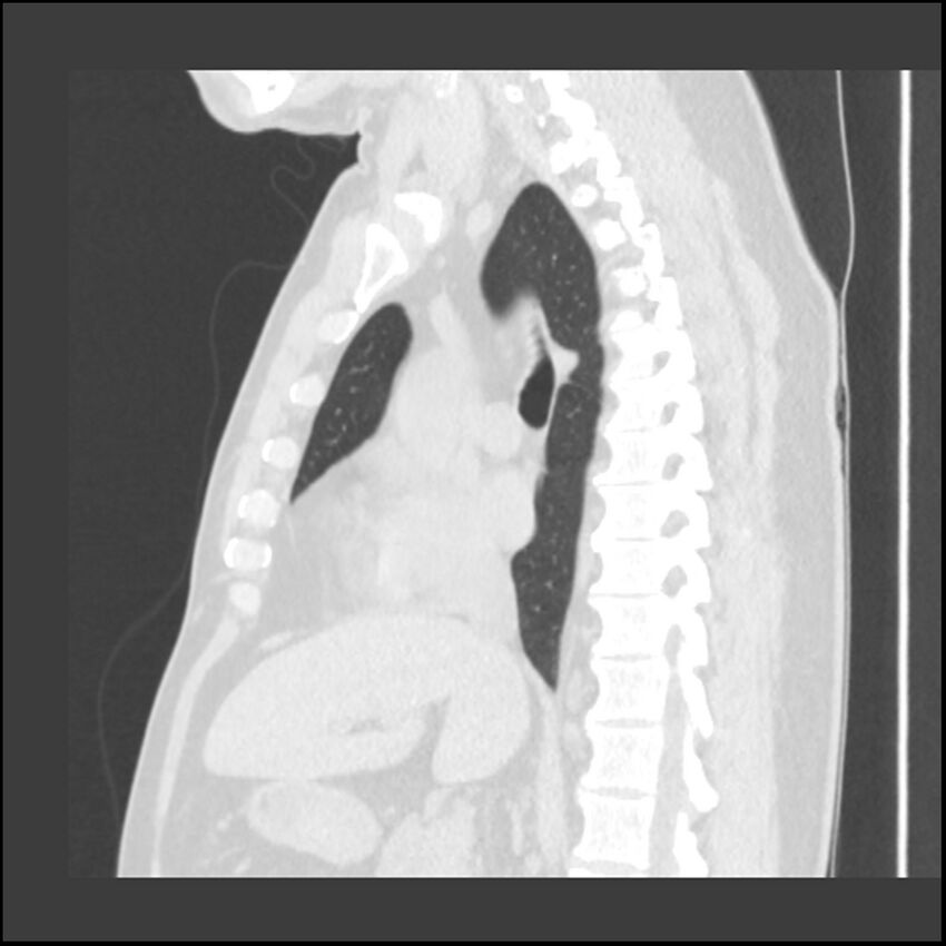 Asbestosis (Radiopaedia 45002-48961 Sagittal lung window 73).jpg
