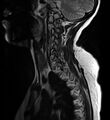 Astrocytoma - spinal cord (Radiopaedia 69769-79758 Sagittal T2 3).jpg