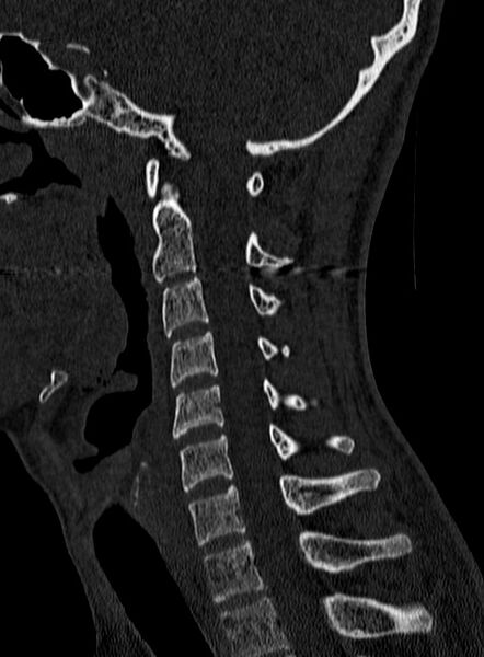 File:Atlantoaxial subluxation (Radiopaedia 44681-48450 Sagittal bone window 87).jpg